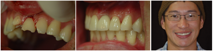 Dental implants and crowns, before and after 