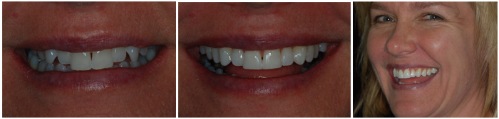 Cosmetic dentistry results, before and after. 